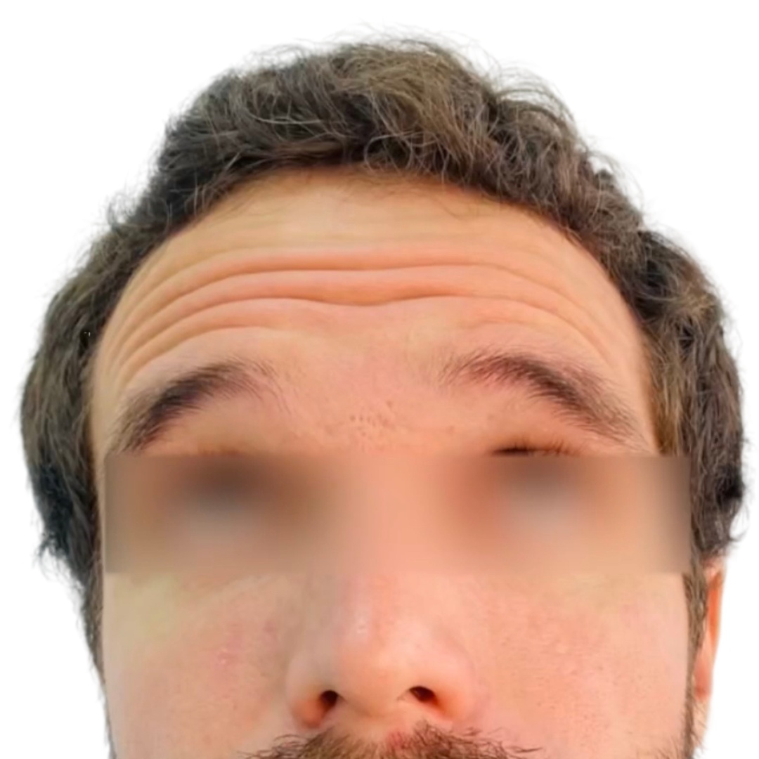 Javier toxina antes